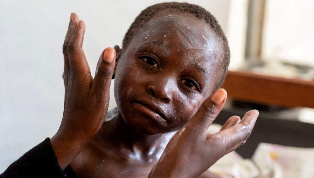 Batı'nın söz verdiği maymun çiçeği aşıları Afrika ülkelerine ulaşmadı Batı'nın söz verdiği maymun çiçeği aşıları Afrika ülkelerine ulaşmadı