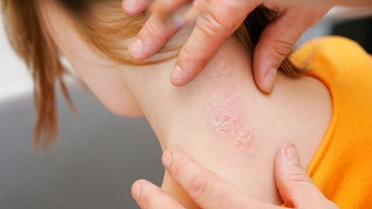 sedef hastalarina keselenmek yasak