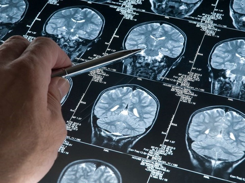 ABD Gıda ve İlaç Dairesi, Alzheimer'ı yavaşlattığı gözlenen yeni ilacı onayladı - 1