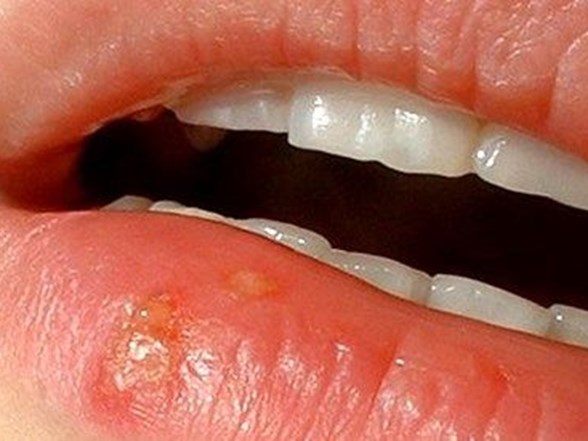 dudakta ucuk cikmasinin nedenleri nelerdir ucuk nasil gecer saglik haberleri ntv