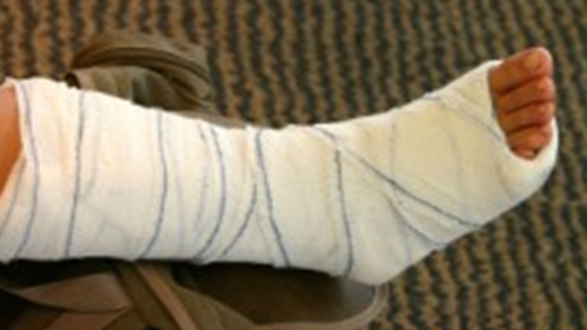 bacagi kirilirsa 1 hafta bilegi