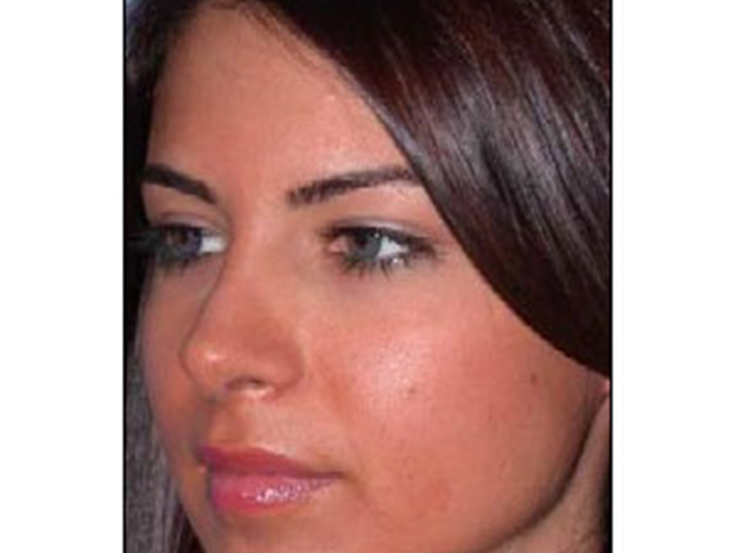 tamponsuz burun estetigi ameliyati