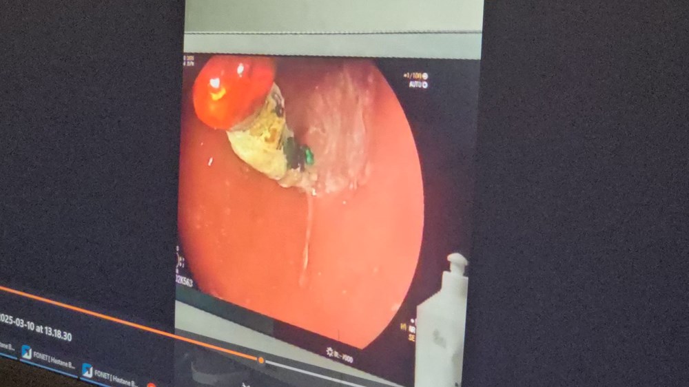 4 Yaşındaki Çocuğun Bağırsaklarında Bileklik Şoku: Doktorlar Gördüklerine İnanamadı! 72 q6tCh1s7c0i8