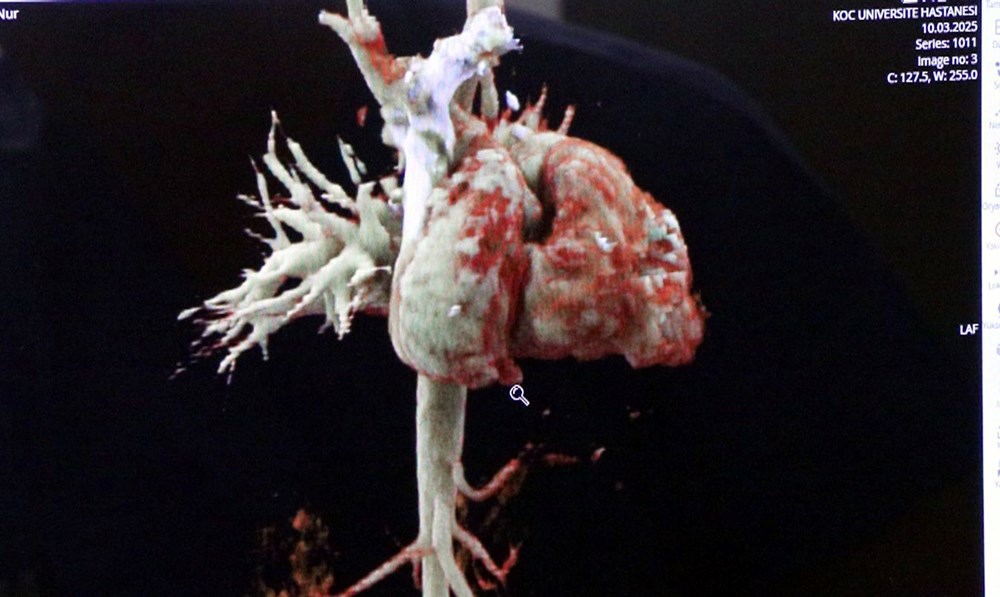 Kalbi "yatay" doğdu, hayatta kalması mucizeydi: Ameliyat sonrası yaşayan ikinci olay 77 qXD03uzx5kGGC 5J4AIwLw