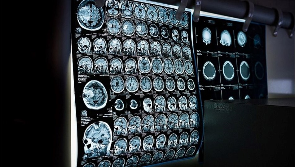 Kanseri erken teşhiste yapay zakadan yüzde 90'lık başarı oranı