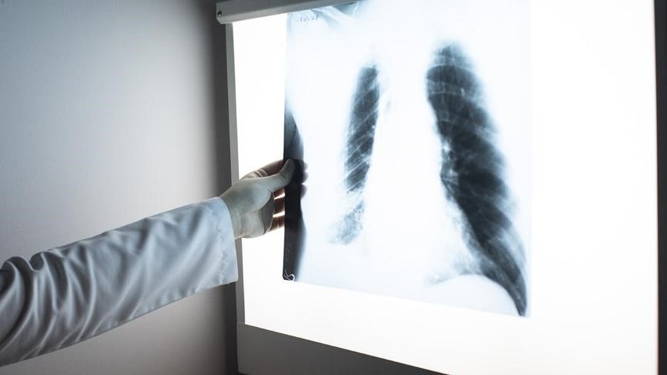 Elektronik sigara kullanımına bağlı akciğer hastalığı tanımlandı: EVALI nedir, belirtileri neler? - 2