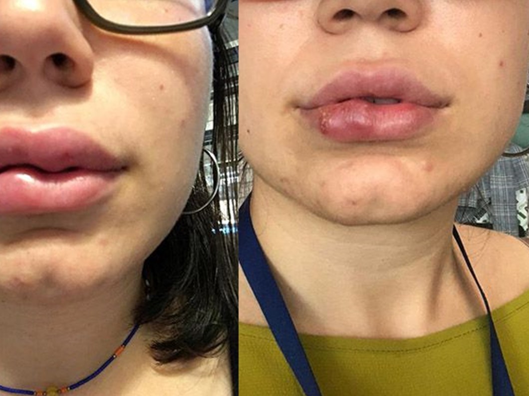 24 Yasindaki Ece Deniz In Dudagi Dolgu Sonrasi Bu Hale Geldi 250 Bin Liralik Dava Acti Ntv