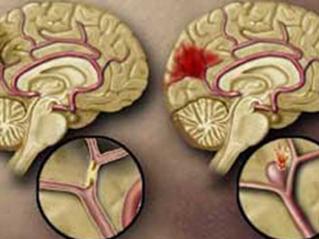 beyin kanamasinda zamanla yarisiliyor