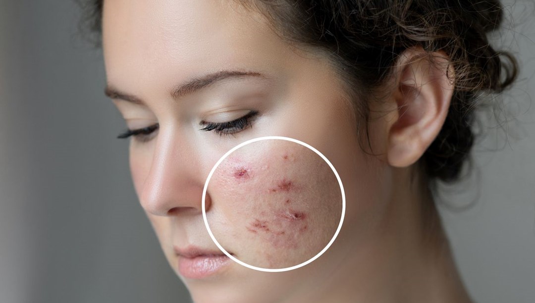 Sivilceleriniz sağlığınız hakkında ne söylüyor? Meğer sadece bir cilt problemi değilmiş