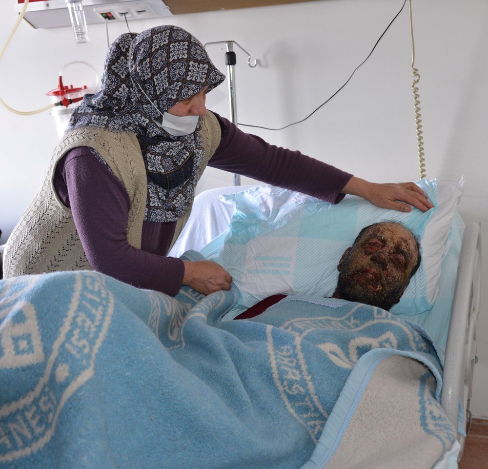 Covid sonrası yüzü çürümeye başladı, aile yardım istedi - 5