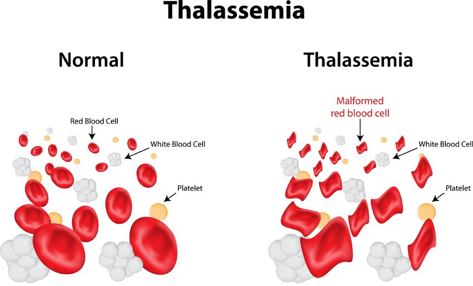 Talasemide kırmızı kan hücrelerinin (alyuvarlar) yapısı değişiyor.