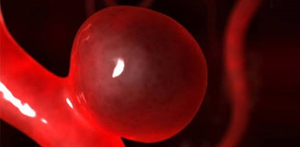 Anevrizma, damarların balonlaşması sonucu gelişiyor.