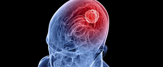 BrainTumor_000011318398Medium-1024x768.jpg