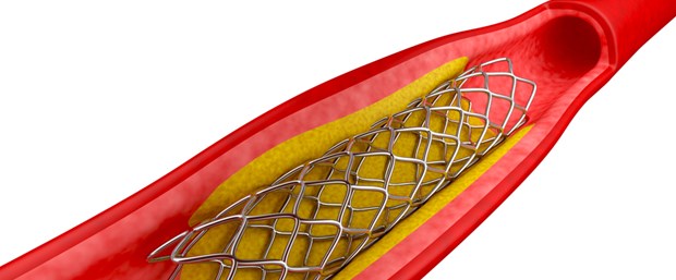 STENT2.jpg