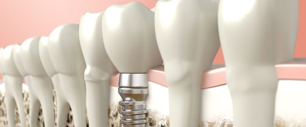 implant.jpg