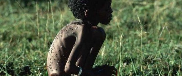 Doğu Afrika'da çocuklar kitleler halinde ölebilir