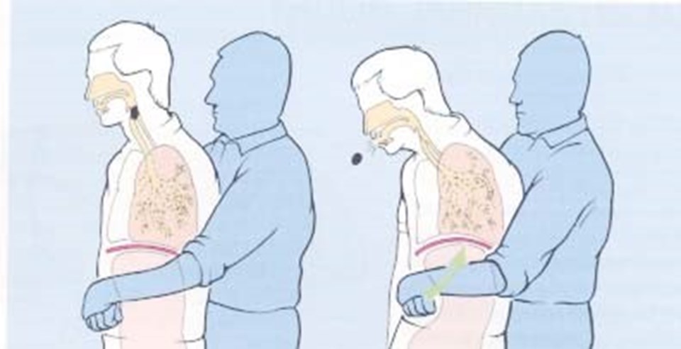 Heimlich manevrası