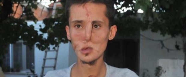İlk soru: Yüzüm nasıl oldu