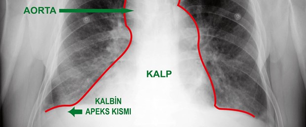 Kalbi sağda bulunan hastaya by-pass