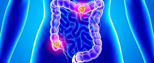 colon-and-rectal-cancers.jpg