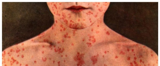 page-42-Does-my-child-have-measles1