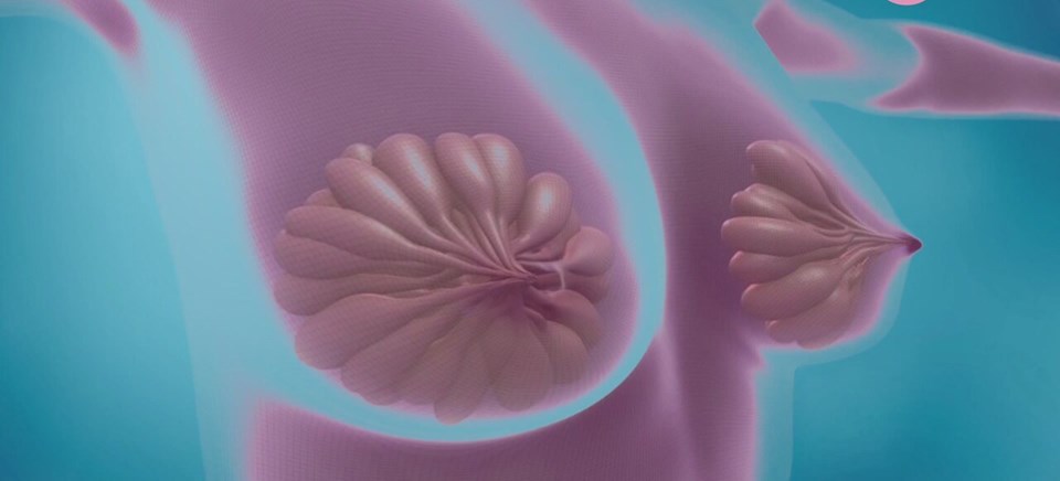 Meme başındaki şekil bozuklukları