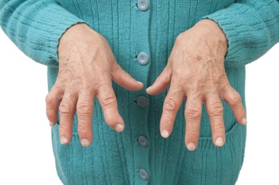 Elledinde romatoid artrit olan bir hasta. 