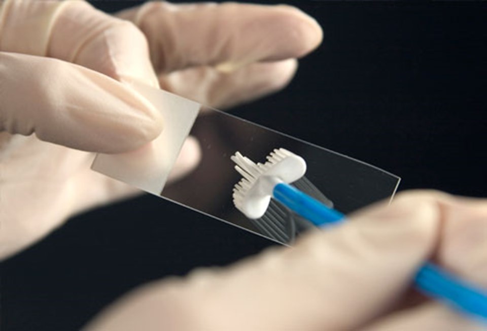 Pap smear testinde rahim ağzından alınan parça inceleniyor.