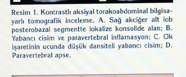 Solunum yoluna kaçtı, sırtından çıktı