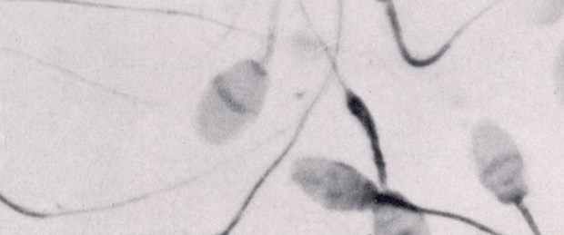 Sperm DNA kırıkları kısırlık nedeni