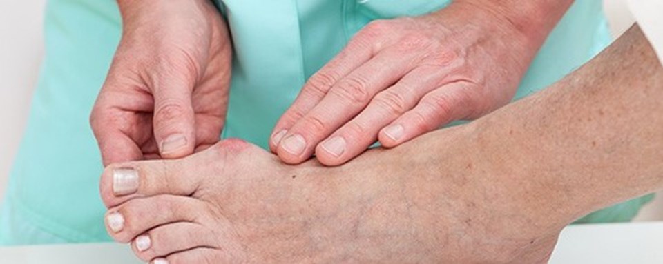 Halluks valgus örneği.