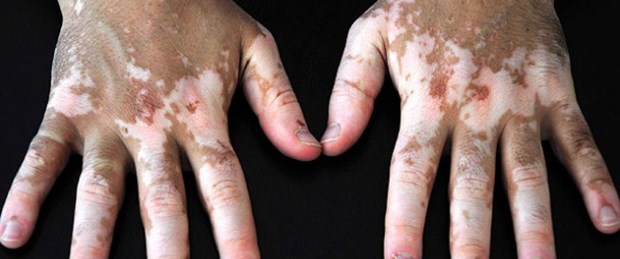Vitiligo tedavisinde umut