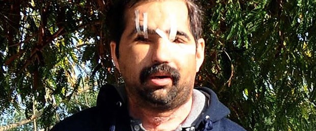 Yüz naklinde üzücü haber
