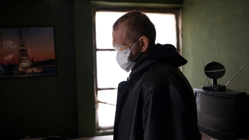 Cilt kanserinden yüzünü kaybeden baba: Kızımı öpmeyi çok özledim - 5