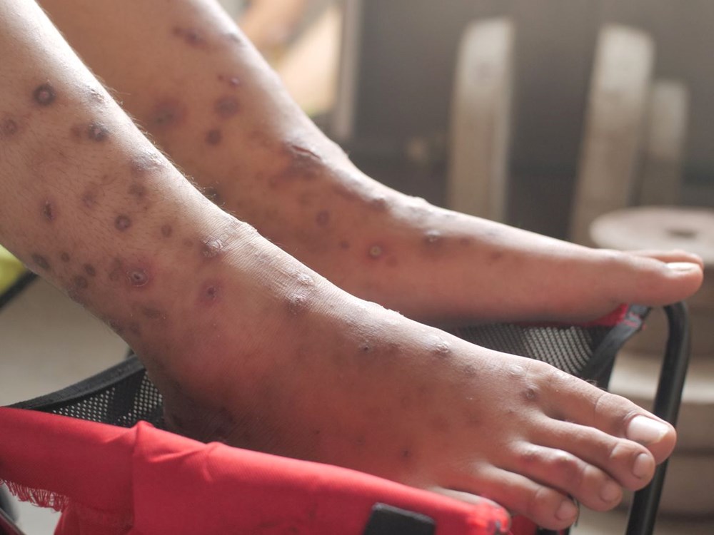 Yeni ölümcül salgın uyarısı: İlaçlara dirençli süper mantar vakaları katlanıyor (Candida auris nedir? Türkiye'de görüldü mü? Ne kadar ölümcül?) - 5