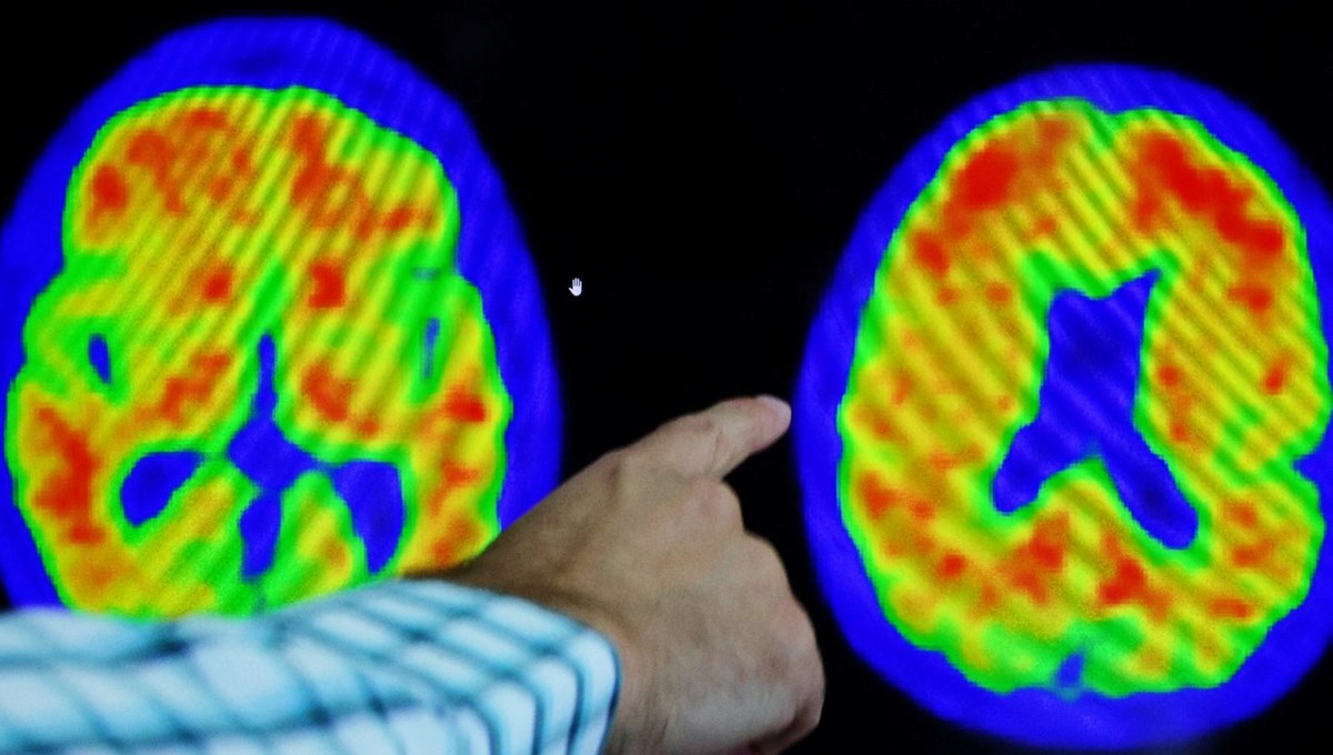Uçuk ve Alzheimer arasında bağlantı
