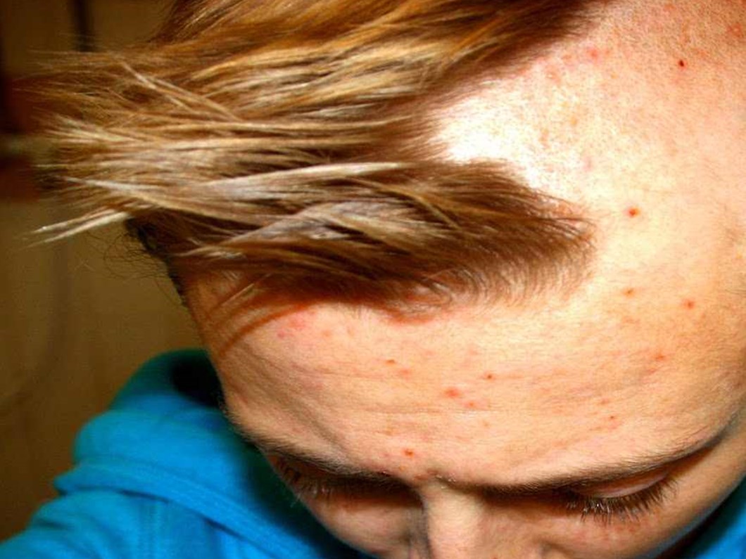 Sac Koparma Tedavi Edilebilir Bir Hastaliktir Trikotilomani Nedir Saglik Haberleri Ntv Sac Koparma Tedavi Edilebilir Bir Hastaliktir Trikotilomani Nedir Saglik Haberleri Ntv