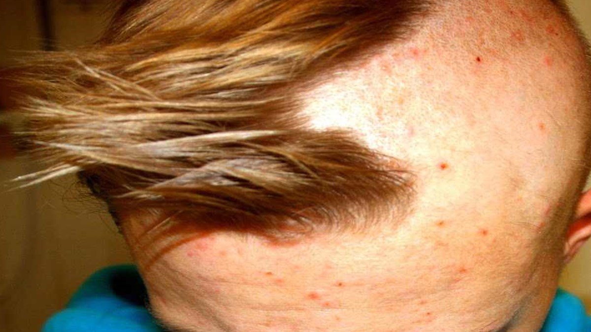 Sac Koparma Tedavi Edilebilir Bir Hastaliktir Trikotilomani Nedir Saglik Haberleri Ntv