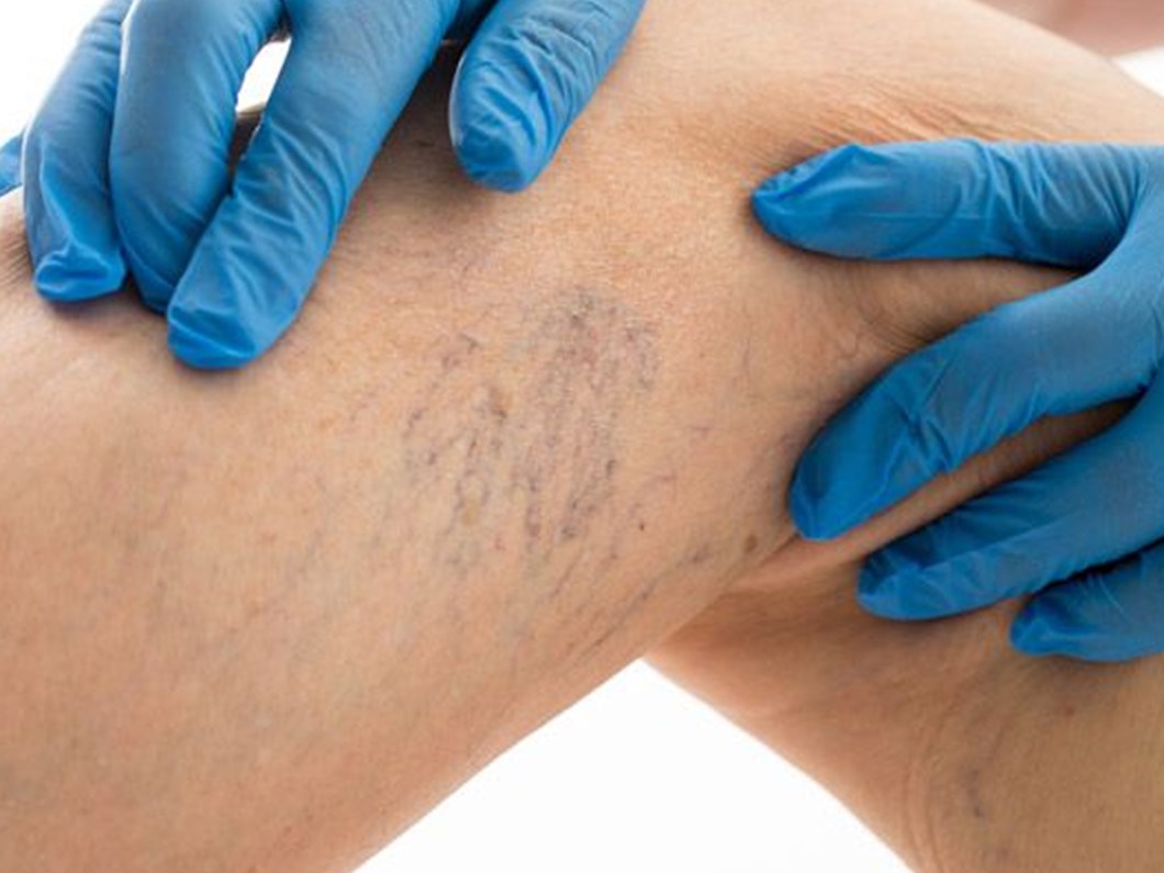 varise evta yontemi ile mudahale