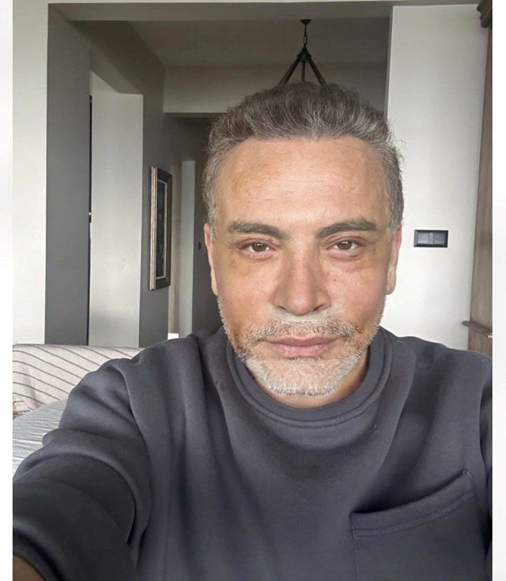 Estetik yaptıran Cenk Eren son halini paylaştı - 2