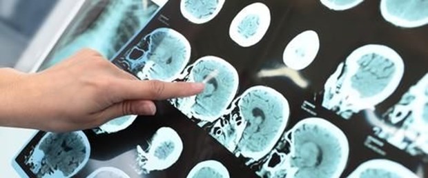 Alzheimer-500x325.jpg