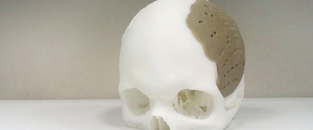 3D yazıcıda kafatası protezi üretildi