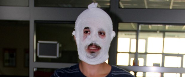 krem yüzünü yaktı.jpg