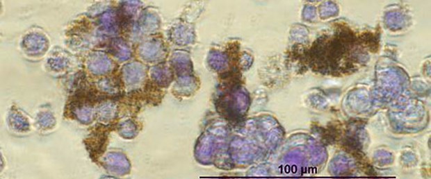 Nanoteknolojiyle kanserde erken teşhis