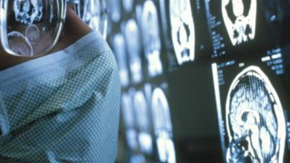 Beyin Tumorune 3 Boyutlu Mr Saglik Haberleri Ntv