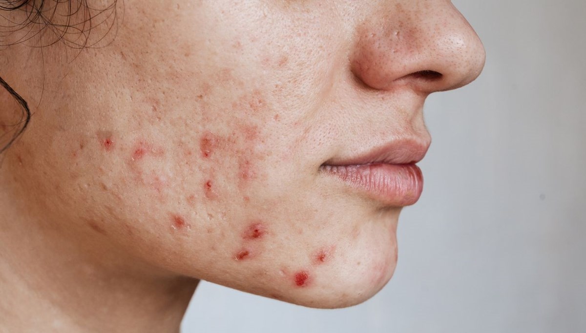 Adet döneminde çıkan sivilce nasıl geçer? Hormonal akneleri kontrol altına almak mümkün Adet döneminde çıkan sivilce nasıl geçer? Hormonal akneleri kontrol altına almak mümkün