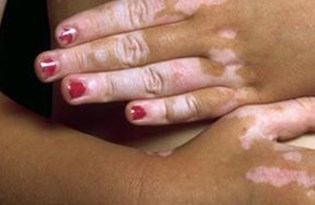 vitiligo nedir neden olusur vitiligo