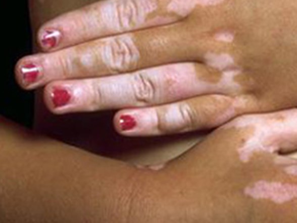 Stres Vitiligoyu Tetikliyor Saglik Haberleri Ntv