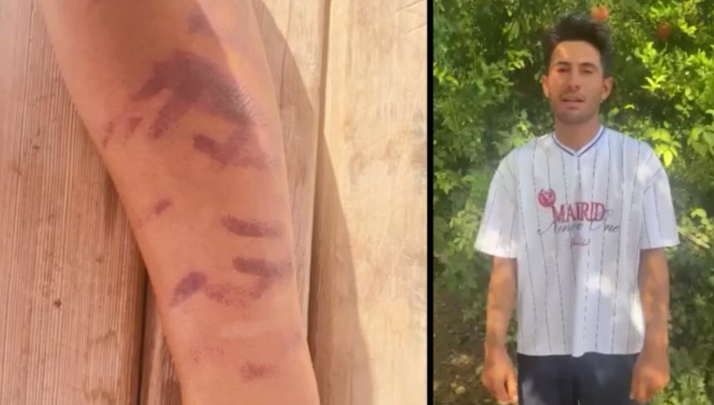 Lazer epilasyon merkezinde kabus yaşadı