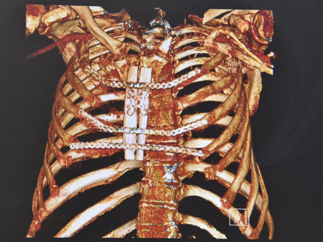 Bacagindan Gogsune Kemik Yapildi Saglik Haberleri Ntv